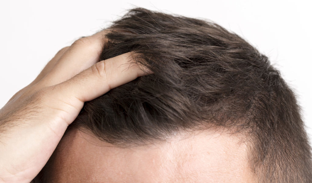 Escala Hamilton-Norwood para medir la alopecia androgénica masculina